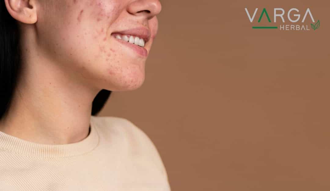 Akne foltok eltüntetése